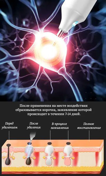 Коагулятор плазмовий, Plasma Pen/Електрокоагулятор/Бездротова ручка для видалення папілом та бородавок G7663 фото