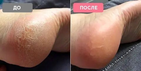 Електрична пемза-пилка для ніг Pedi Vac Прилад для видалення мозолів з вакуумним пилососом акумулятор USB ja8852 фото