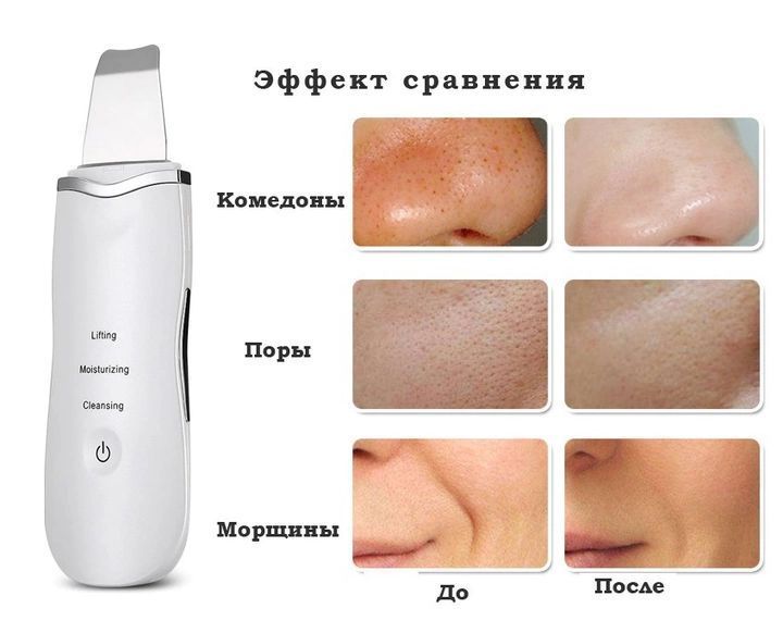 Апарат для ультразвукового чищення обличчя Ultrasonic Shovel 5401142 фото